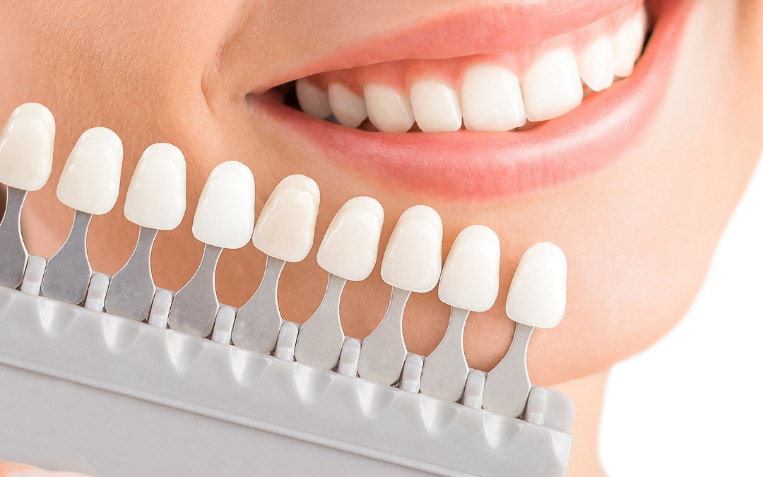Top 5 Reasons to Whiten Your Teeth